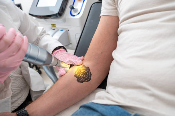 détatouage laser à Villefranche