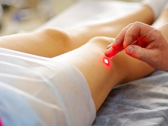 Laser endoveineux
